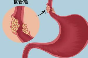 食道癌VS咽炎有什麼區別？這5個症狀，提前發現一個就很好