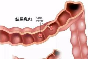 別把腸息肉拖成腸癌！腸內長了息肉，身體會有3種異常，不可大意