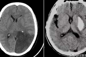 40歲年輕小伙出現腦梗，危害巨大！我們應該如何預防腦梗？