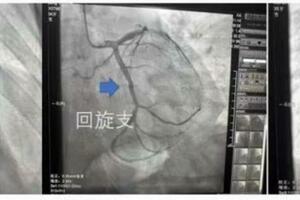 35歲男子熬夜加班突發心梗血管如80歲老人 醫生：年輕人心梗比老人更危險