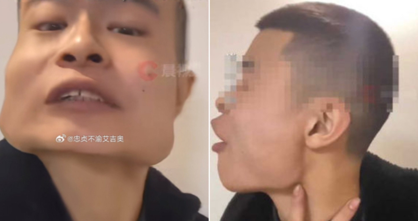 18歲男「檳榔吃8年」　瓜子臉變「方塊臉」網見畫面嚇愣