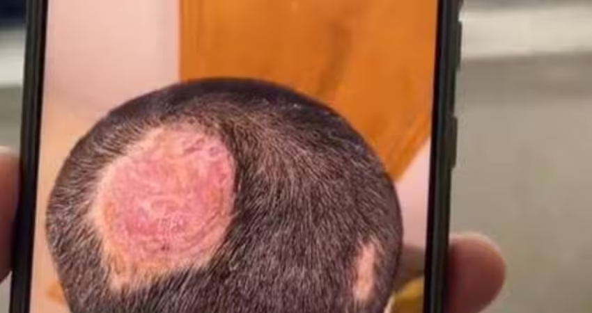 6歲童長膿癬永久禿頭！醫檢查驚「兇手竟是1寵物」3症狀快就醫