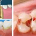 牙科醫囑大全。如果你的牙齒正在治療中一定要看看不用怕，拔牙+洗牙+根管治療