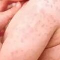 不管長啥疹子，記住3點就夠了！蕁麻疹、濕疹、痱子都適用