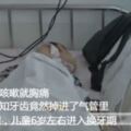 孩子一咳嗽就胸痛，醫生通過消化內鏡手術，竟然在男童的氣管裡取出一顆乳牙。