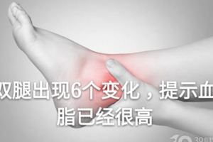 雙腿出現6個變化，提示血脂已經很高