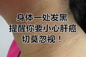 身體一處發黑，提醒你要小心肝癌，切莫忽視！