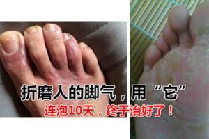 折磨人的腳氣，用「它」連泡10天，終於治好了！