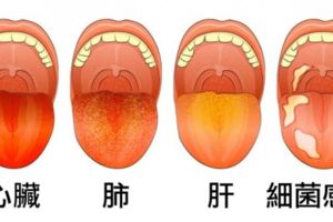 現在伸出你的舌頭就能快速檢測「身體哪裡有毛病」，紫色舌頭的疾病實在太糟糕了！