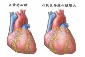 29歲女子感冒後心跳只有25次/分，經搶救51小時仍無力回天！