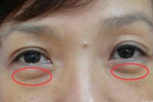 眼袋下垂別急著打玻尿酸！「1塊錢」的它，能輕松收緊眼袋
