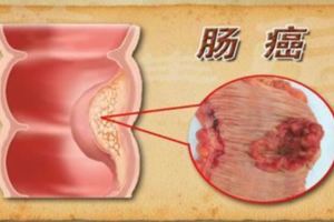 央視主持人肖曉琳直腸癌去世，什麼人群容易得直腸癌？