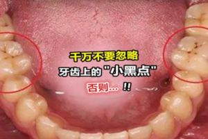 為什麼「牙齒上會有黑線」?原來牙齒溝出現「黑黑的」,竟然會導致…太可怕了!