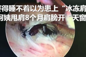 疼得睡不著以為患上「冰凍肩」阿姨甩肩8個月肩膀開「天窗」