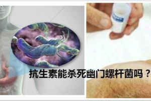 抗生素能殺死幽門螺桿菌嗎？一些胃病患者入院檢查時幽門螺桿菌