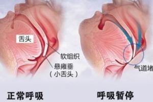 阻塞性睡眠呼吸暫停，造成健康危害，糖尿病、肥胖、癌症等慢性病風險