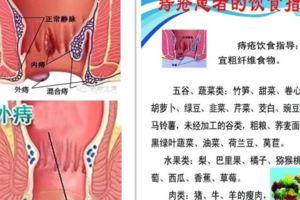 痔瘡吃什麼好？分內痔、外痔、混合痔三種，臨床治療