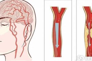 終於找到腦梗元兇了！醫生提醒：不想腦梗來侵犯，3個位置要常動