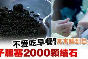 長期不吃早餐惹禍？女子膽結石2000顆